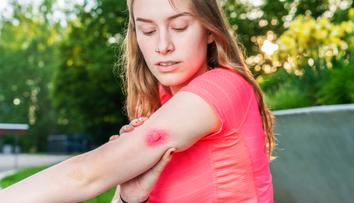Co dělat po bodnutí hmyzem nebo vyndání klíštěte? Dermatoložka řekla, kdy vyhledat lékaře