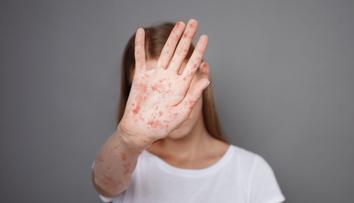 V Chorvatsku řádí nebezpečná infekce. Ohroženi jsou dospělí i děti