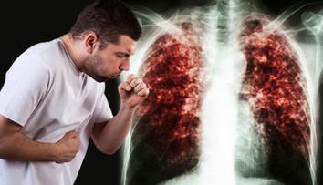 Tuberkulóza v ČR po krajích: Kolik nakažených hlásí u vás? PŘEHLED