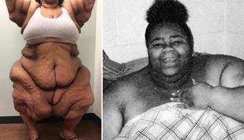 Musíte vidět: Nejtěžší žena světa shodila 200 kilogramů! GALERIE