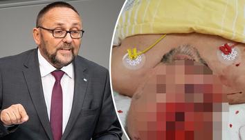 Poslance AfD v Brémách brutálně napadli. Je vážně zraněný