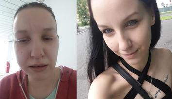 Hororový zubař v Teplicích! Žena má po zákroku zničené zuby i dásně