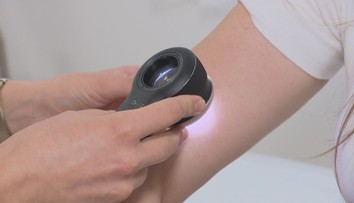 Pacientů s rakovinou kůže v Česku přibývá. Lékaři radí, jak se chránit