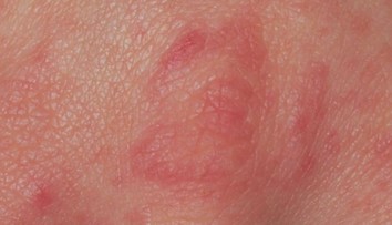 V Humpolci se mezi dětmi rozšířil svrab. Platí přísná hygienická opatření