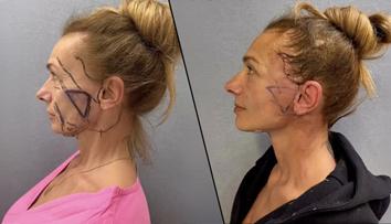 Je to venku! Alice Bendová ukázala tvář po faceliftu