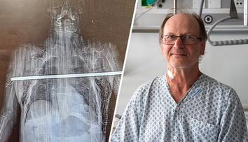 Trhal třešně, spadl a obě plíce mu propíchla tyč. Lékaři mu otevřeli hrudník