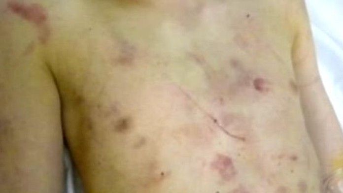 Mladá matka lámala synovi devět kostí šest měsíců. Pořád někde běhal, stěžovala si