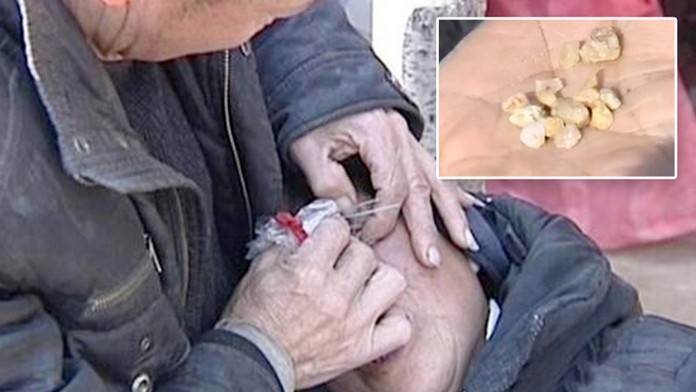 Pláč ženě působí muka: Místo slz brečí kameny! FOTO PRO OTRLÉ