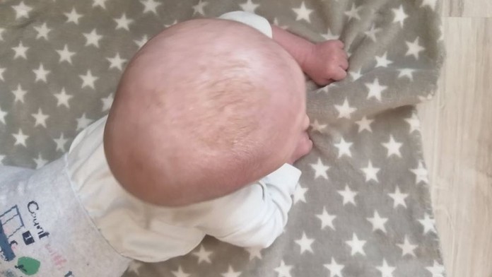 Obří boule na hlavě ničí miminku život. Ortézu pojišťovna neproplatí
