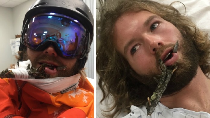 Piercing ze stromu! Lyžaři protla větev tvář a teď nemá na operaci