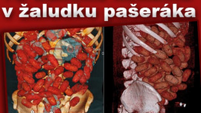 Pašerák měl v žaludku 72 balíčků kokainu