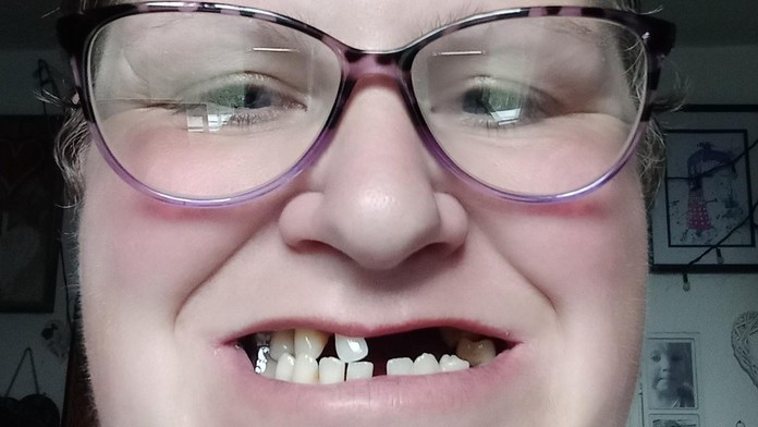 Žena neměla peníze na zubaře. Sama si tak vytrhala 13 zubů
