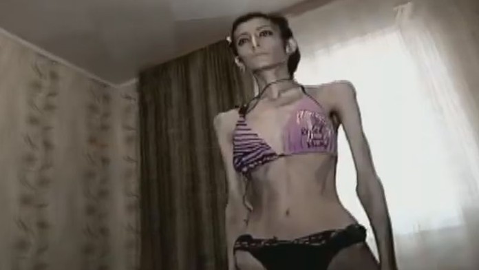 Dívka (23) přestala jíst po rozchodu! Nyní váží už jen 21 kilo