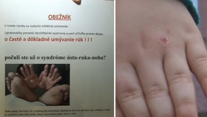 Ničí jim ruce! Na Slovensku zasáhla děti podivná choroba