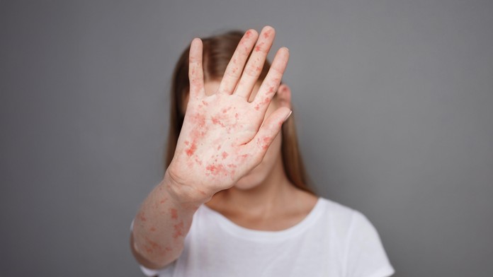 Epidemie spalniček na vzestupu. Kdo je nejvíc v ohrožení?