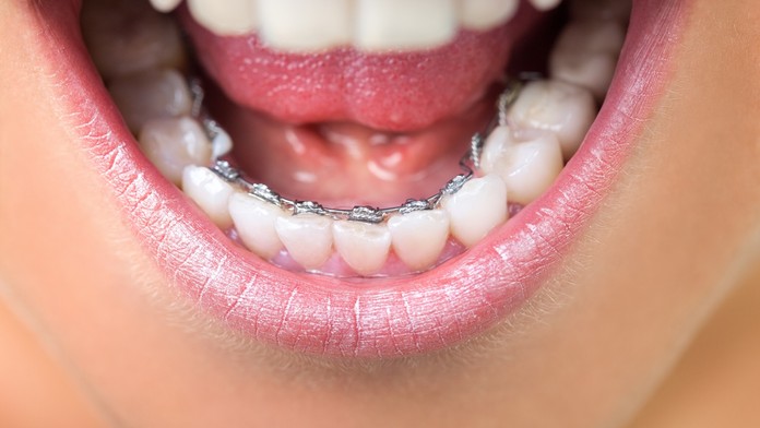 Konec studu kvůli křivým zubům a rovnátkům. Pořiďte si ta neviditelná