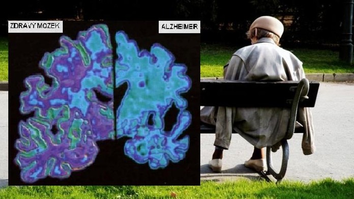 Tajemství Alzheimera? Vědci už ví, která látka nemoc rychle zhoršuje