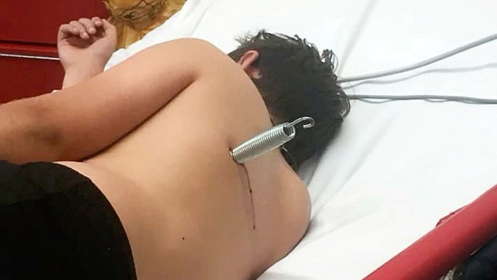 Hra na trampolíně se změnila v horor! Chlapec skončil s pružinou v zádech