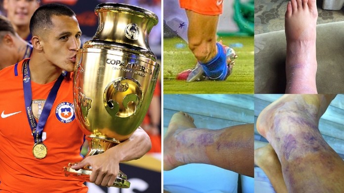Tohle je můj kotník! Superstar z Arsenalu vyděsila fanoušky