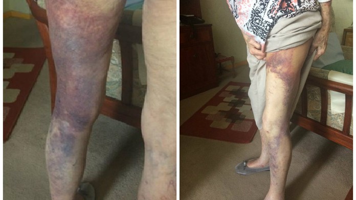 Lupič přepadl babičku (92) kvůli stovce! Utrpěla děsivá zranění
