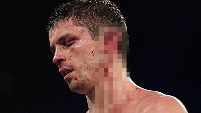 Soupeř rozpůlil Smithovi ucho. Takhle vypadá boxer dnes! FOTO