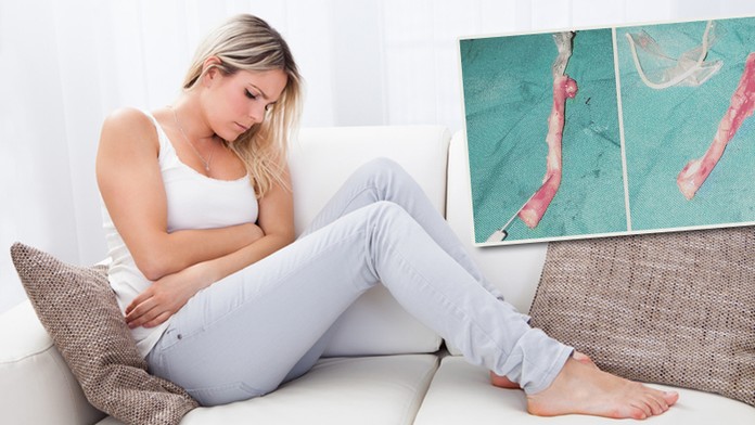 Žena šla k lékaři s bolestí břicha. Co jí našli ve slepáku, je šokovalo