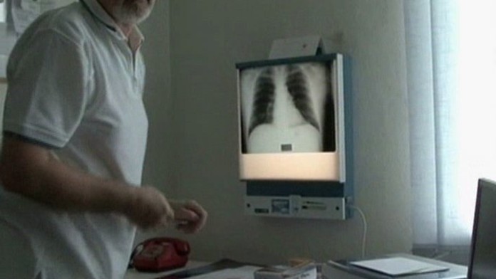 Ve vsi chodil muž nakažený tuberkulózou