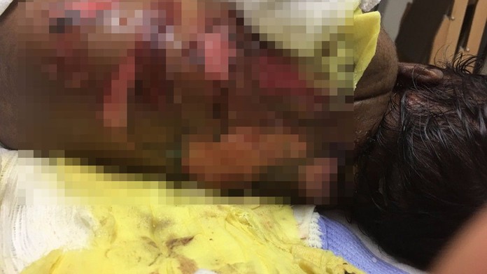 Máma nemůže své dítě obejmout! Chlapeček trpí, ztratil většinu kůže