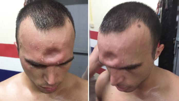 Thaiboxer skončil s dírou v čele, přesto chtěl zápasit dál!