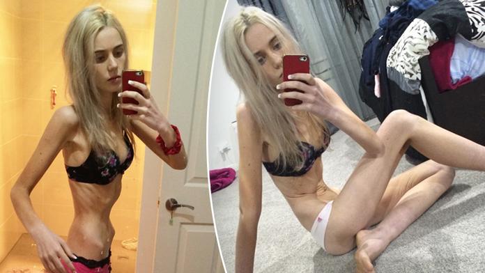 Ellen (19) vážila jen 35 kilo, od smrti ji dělily minuty! VIDEO