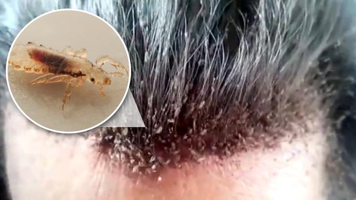 Vši útočí! Během tohoto videa se nevydržíte neškrábat ve vlasech