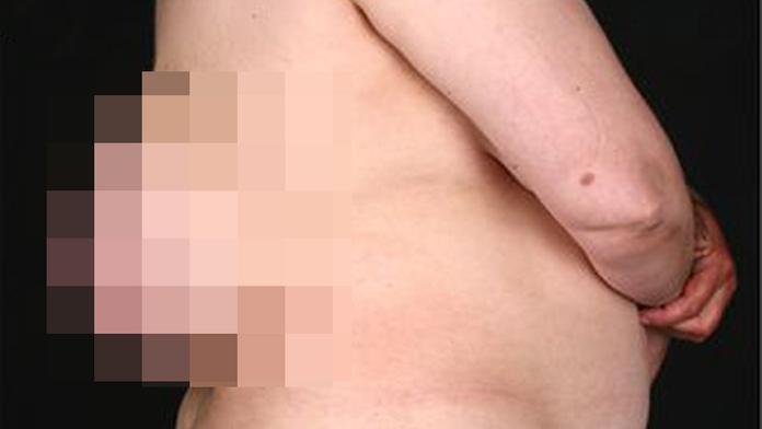 Ženě vyrostlo na zádech "třetí prso"! Nechala ho růst 10 let