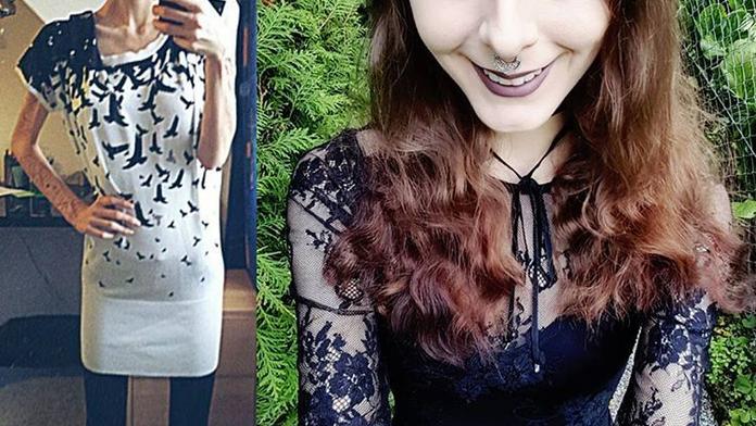 Julie trpěla anorexií. Aby nemusela jíst, schovávala si jídlo do uší