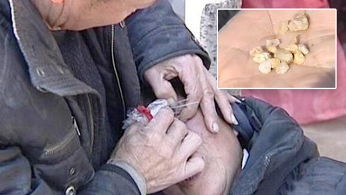 Pláč ženě působí muka: Místo slz brečí kameny! FOTO PRO OTRLÉ