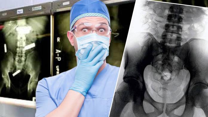 Šílená GALERIE: Tohle všechno už doktoři našli lidem v žaludku!