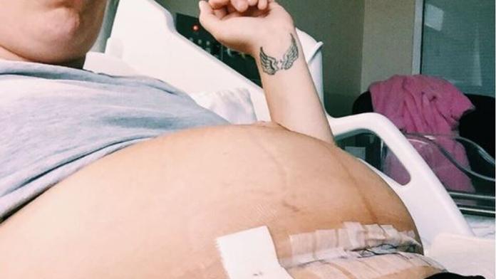 Že je císařský řez "snadná cesta"? Maminka zveřejnila děsivé selfie!