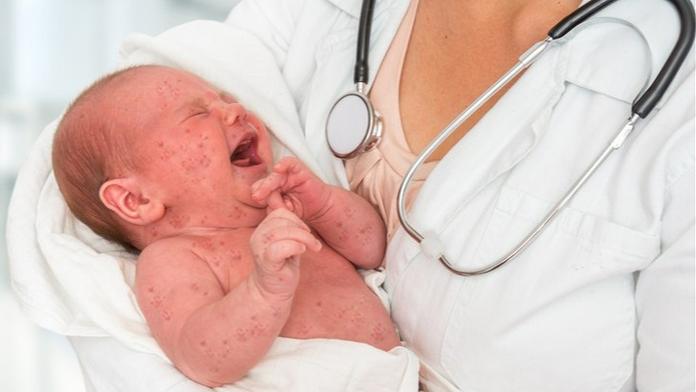 V Evropě se šíří extrémně nakažlivá nemoc. Případy hlásí i Česko