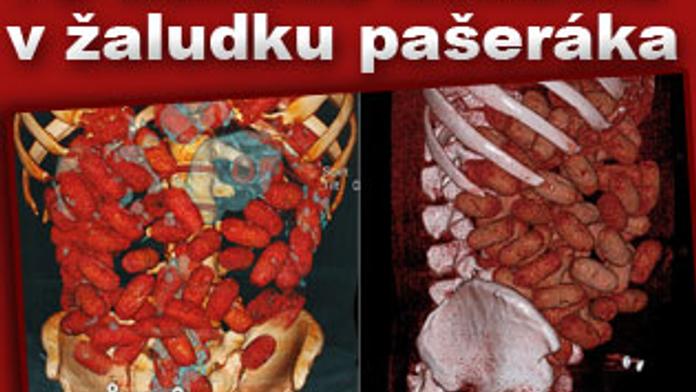 Pašerák měl v žaludku 72 balíčků kokainu