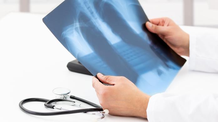 Průlom v boji s rakovinou plic? Vědci chystají preventivní vakcínu
