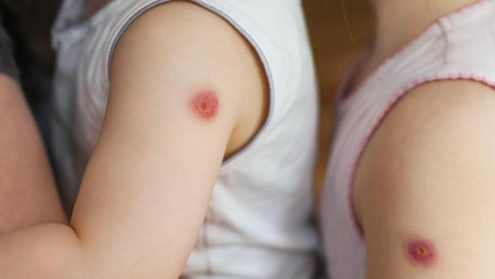 Indií se šíří vysoce nakažlivá nemoc. Lidé mají puchýře, které vypadají jako rajčata