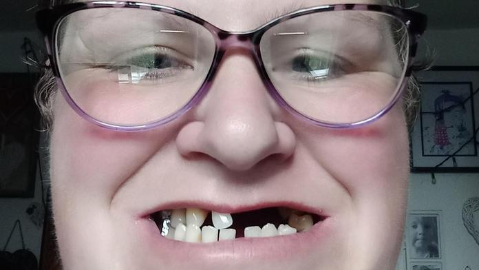 Žena neměla peníze na zubaře. Sama si tak vytrhala 13 zubů