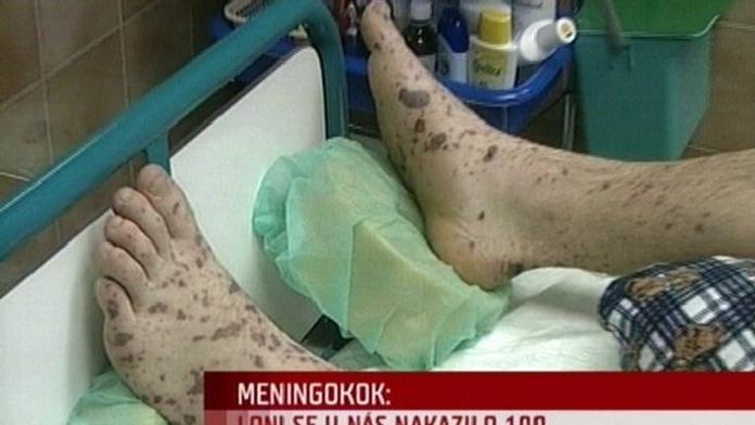 Dívka leží s meningokokem v hradecké nemocnici