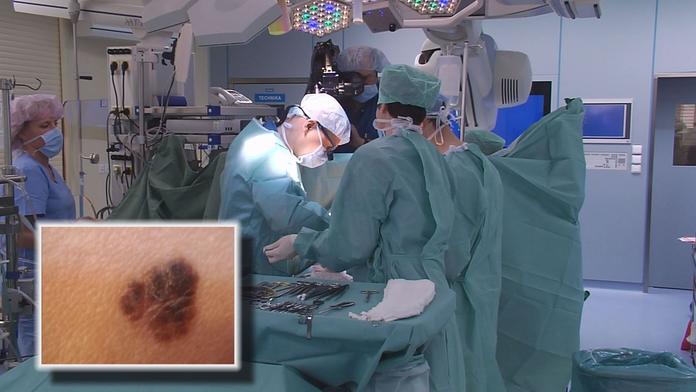 Vědci zvládli nemožné! Test odhalí rakovinu kůže dřív, než je vidět