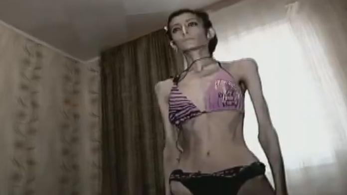 Dívka (23) přestala jíst po rozchodu! Nyní váží už jen 21 kilo