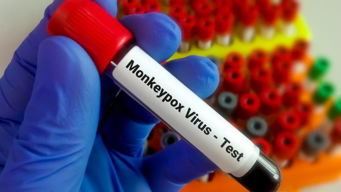 Opičí neštovice nejen z Belgie. Hygiena prozradila, kde se Češi asi nakazili