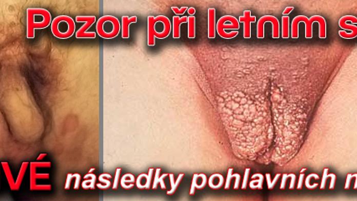 Pozor při letním sexu: DĚSIVÉ následky pohlavních nemocí