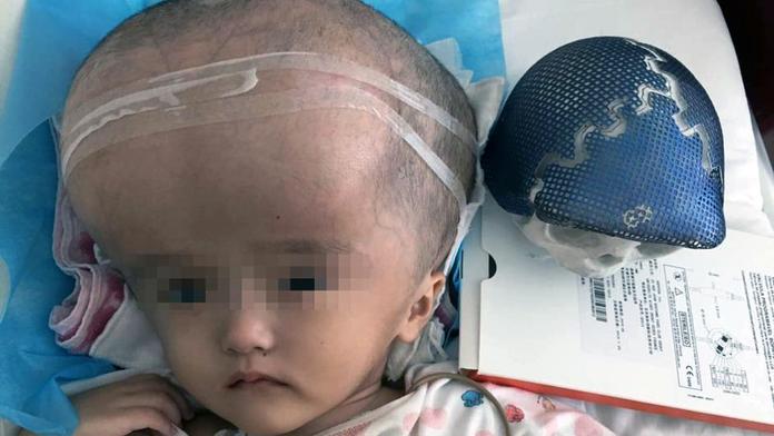 Dívenka měla obří hlavu. Novou lebku jí vyrobili na 3D tiskárně