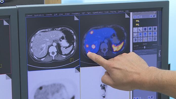 Lékař varuje před přehlíženou rakovinou. Jeden symptom nesmíte ignorovat
