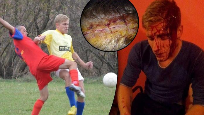 HRŮZA! Anglického fotbalistu napadli v Rumunsku sekerou!