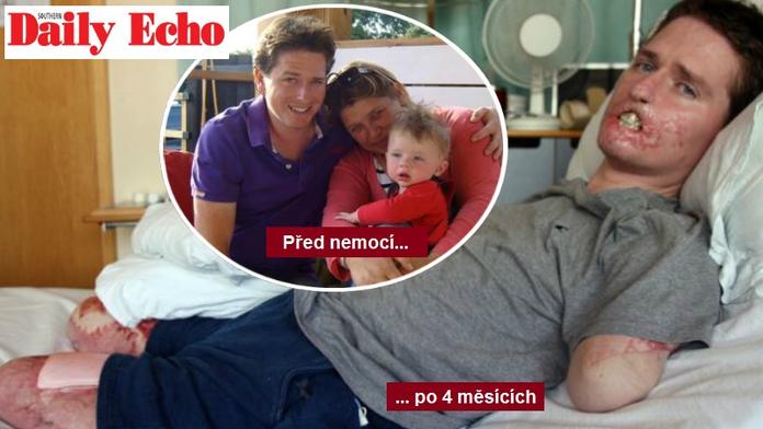 Muže napadla zákeřná bakterie. Za 4 měsíce ho téměř sežrala zaživa!